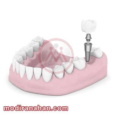 کاربرد فلزات در دندانپزشکی به عنوان ایمپلنت